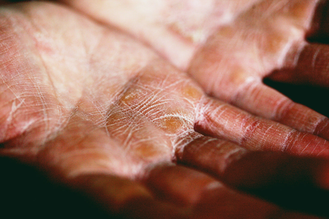 Dry hands as a result of dehydration