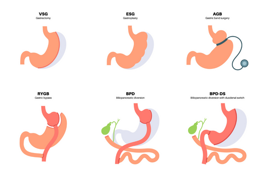 9 Different Types of Weight Loss Surgery (Complete Guide)