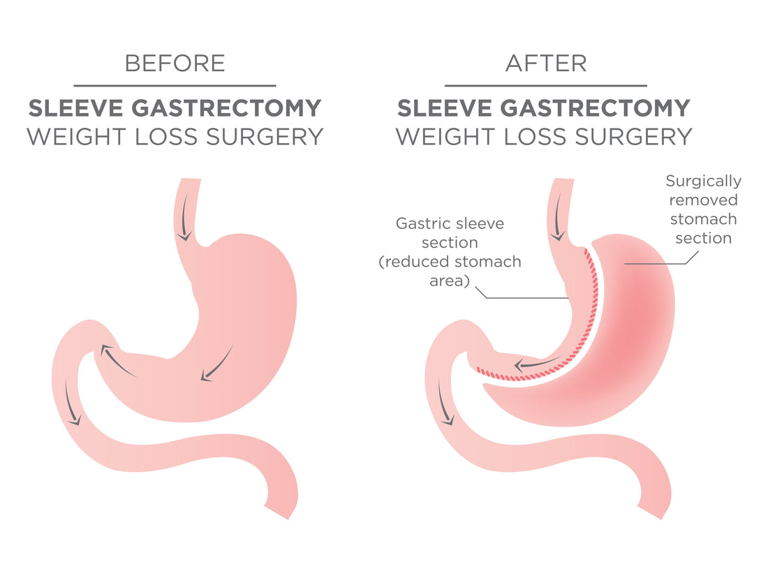Before and after diagram of weight loss surgery