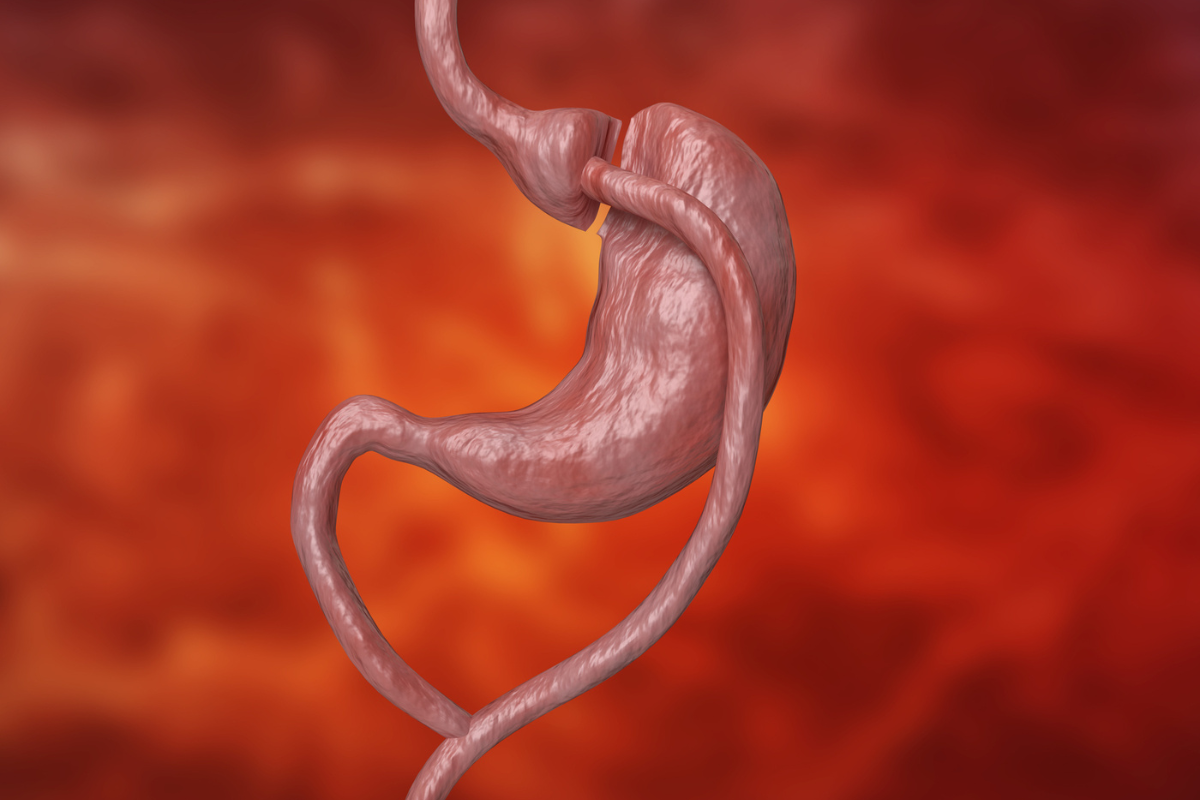 can-gastric-bypass-be-reversed-barislim