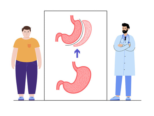 Laparoscopic sleeve gastrectomy 