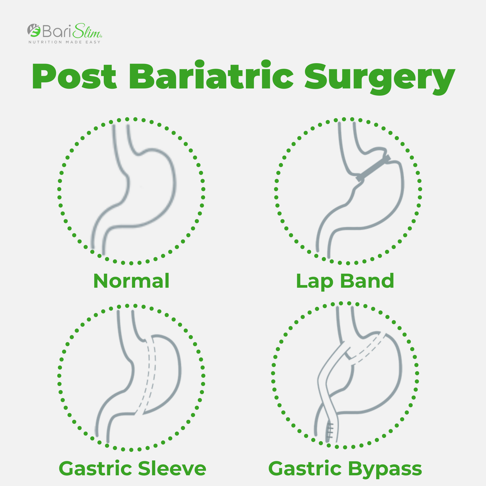 Gastric sleeve after surgery