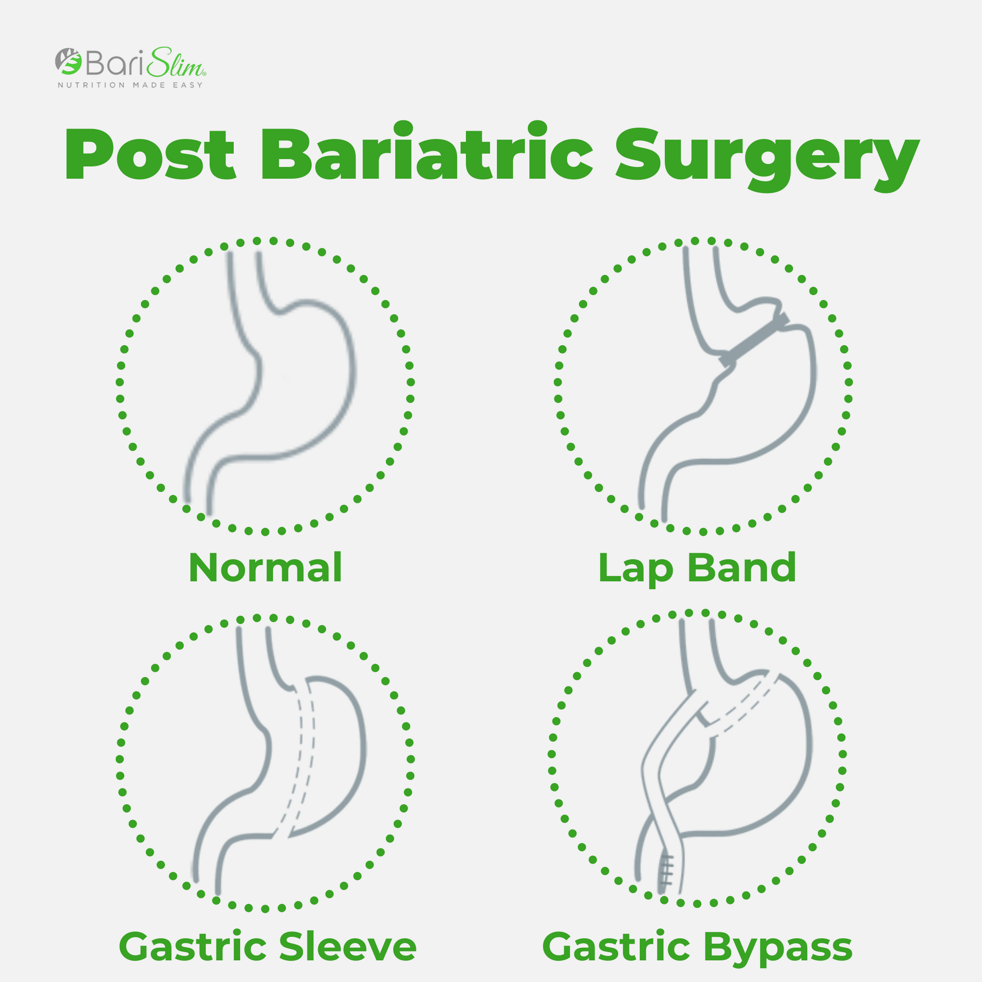 Post Bariatric Surgery - lap band, gastric sleeve and gastric bypass